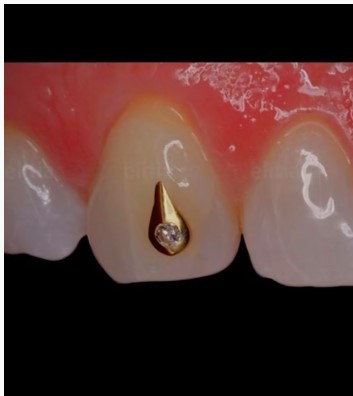Tooth Piercing or Dental Piercing _6
