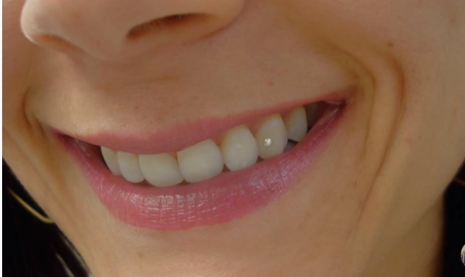 Tooth Piercing or Dental Piercing _8